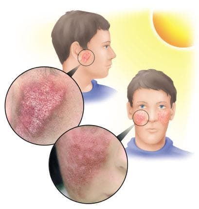 Аллергия на солнце и тепло