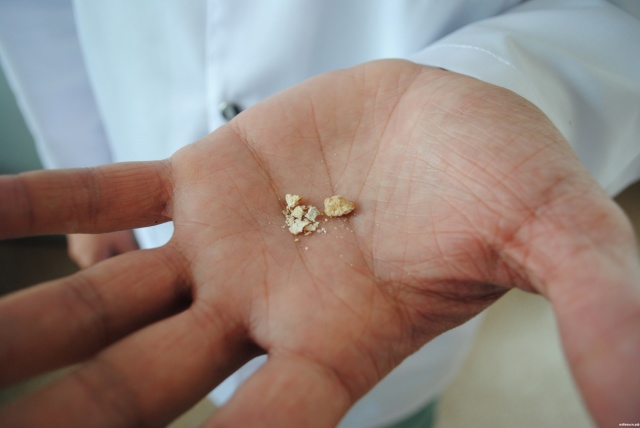 Лечение Как лечить камни в почках в Краснодаре в Клинике Фомина
