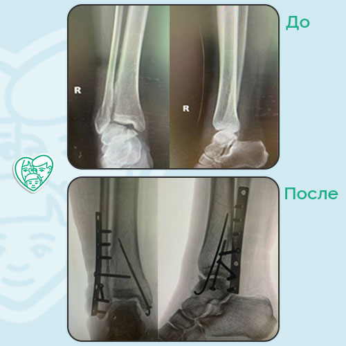 Остеосинтез перелома лодыжек голени