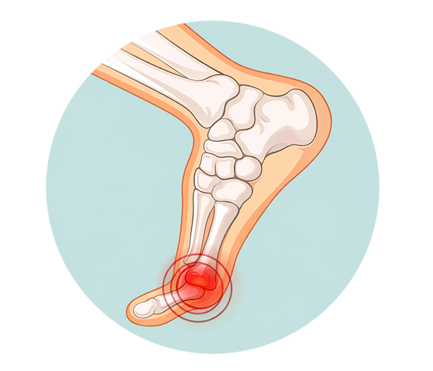 Диагностика стопы при вальгусной деформации