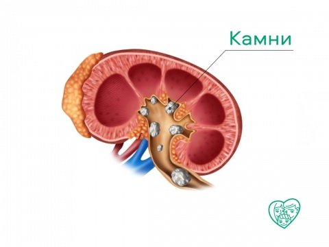 Камни в мочеточнике - симптомы, признаки и лечение у мужчин и женщин в Москве в «СМ-Клиника»