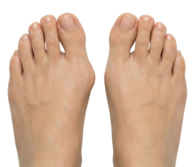 Диагностика стопы при вальгусной деформации