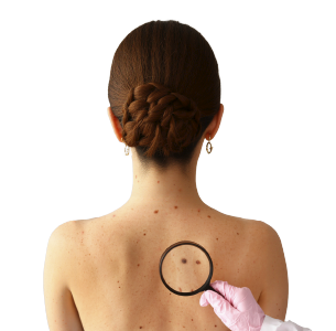 Бесплатная диагностика родинок и скидка 20% на удаление