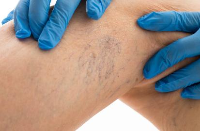 Проверьте свои вены на варикоз!