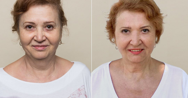 Трансконъюнктивальная блефаропластика