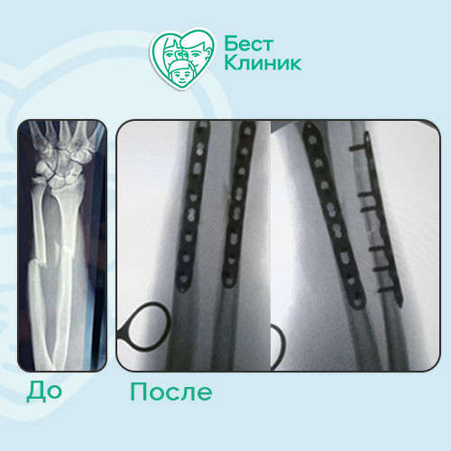 Остеосинтез перелома костей предплечья