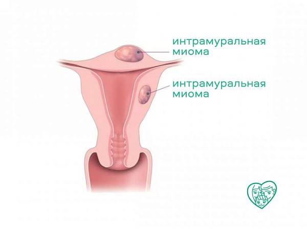 Интрамуральная миома матки