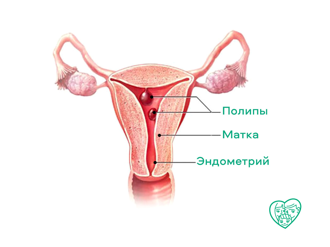 Полип шейки матки, полип цервикального канала, полип эндометрия: диагностика и удаление