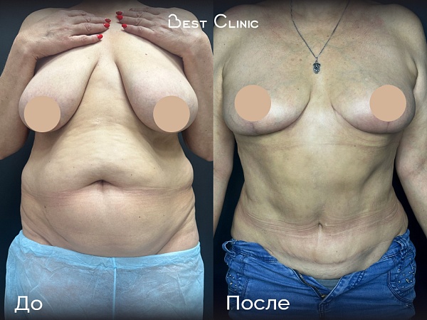 Редукционная мастопексия + абдоминопластика + липосакция