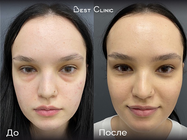 Нижняя трансконъюктивальная блефаропластика