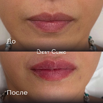 Контурная пластика губ