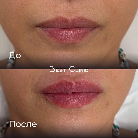 Контурная пластика губ