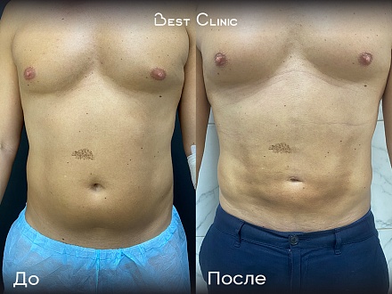 Липосакция 360