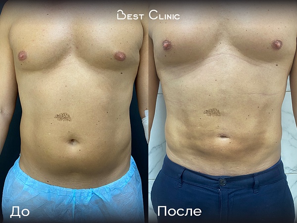 Липосакция 360