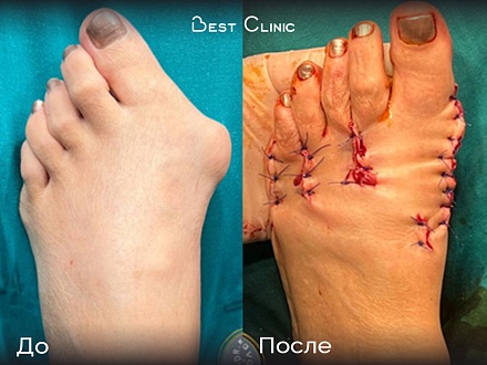Реконструктивно-пластическая операция на переднем отделе стопы (Hallux Valgus)