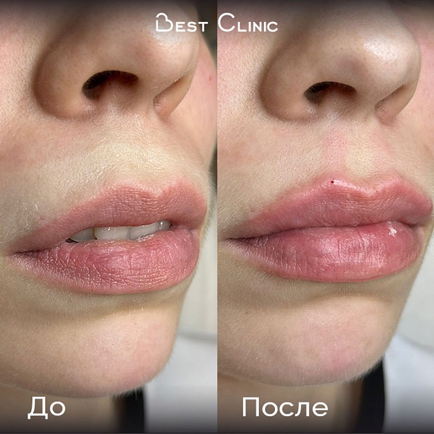 Контурная пластика губ (Belotero Lips Shape)
