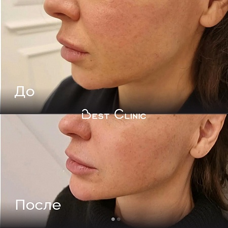 Контурная пластика нижней третий лица