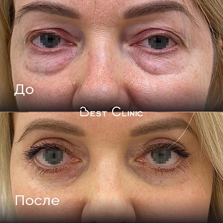 Верхняя и нижняя блефаропластика