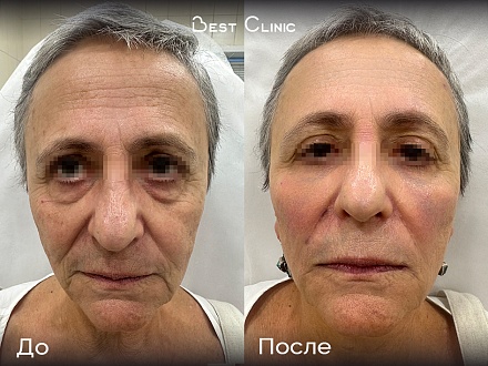 Объемное моделирование лица Full Face препаратом гиалуроновой кислоты