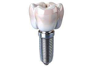 Имплантация зуба «Под ключ»