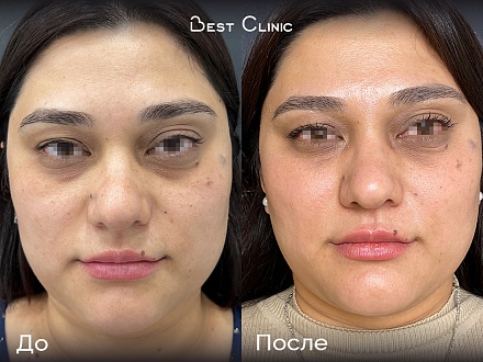 Фототерапия М22