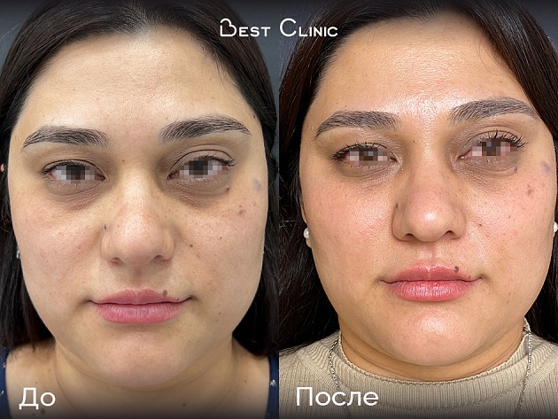 Фототерапия М22