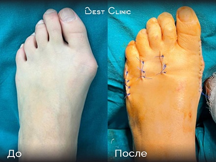 Реконструктивно-пластическая операция на переднем отделе стопы (Hallux Valgus)