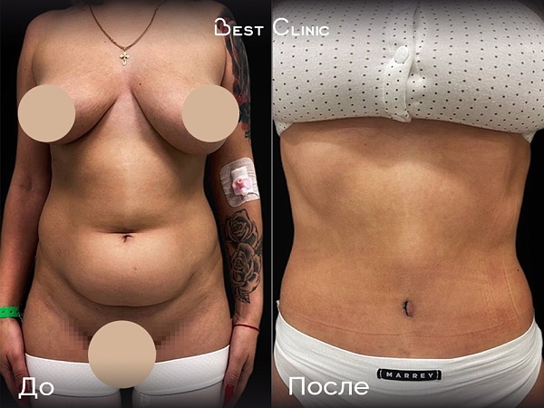 Абдоминопластика