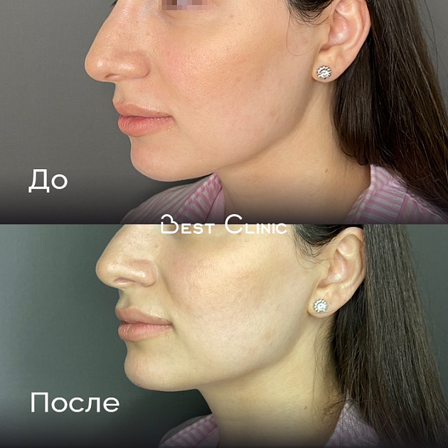 Контурная пластика подбородка препаратом Teosyal Ultra Deep