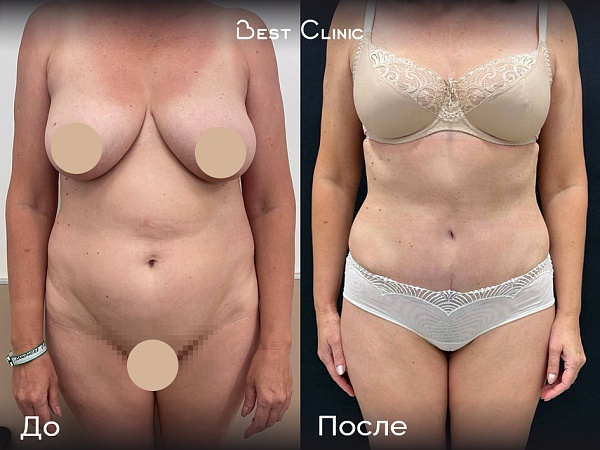 Абдоминопластика