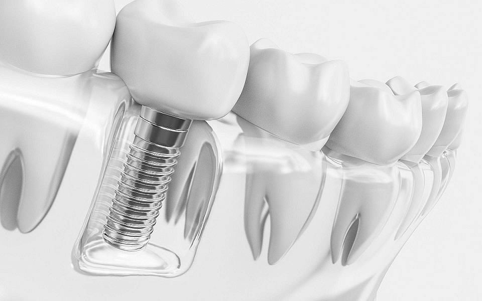 Зачем нужна имплантация зубов