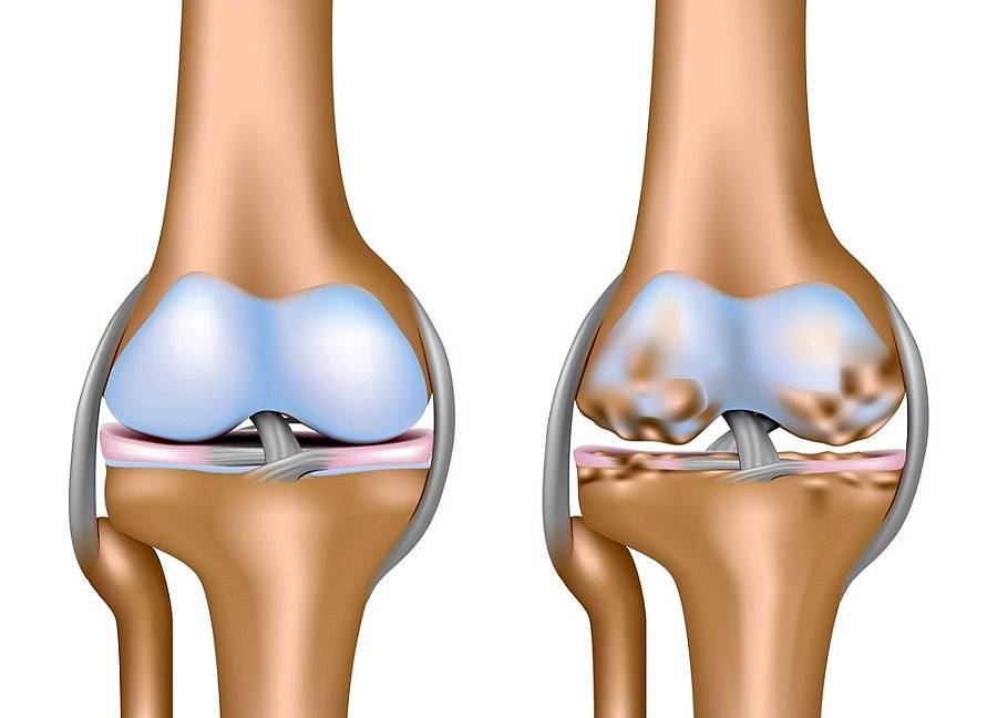 Виды деформирующих артрозов коленного сустава