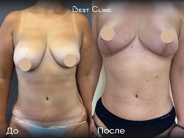 Липоабдоминопластика, мастопексия без имплантов (в два этапа)