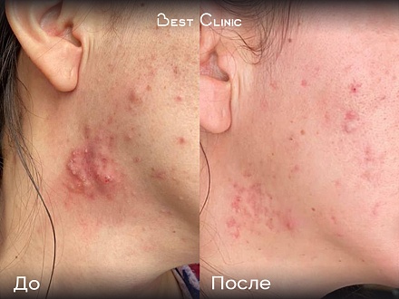 Лечение акне системными ретиноидами