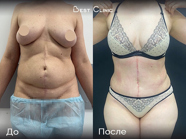 Липоабдоминопластика + герниопластика + абдоминопластика