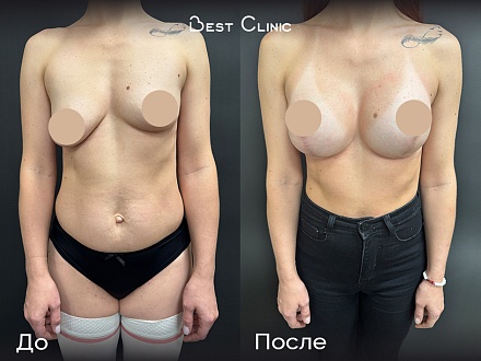 Подтяжка с увеличением. Коррекция асимметрии