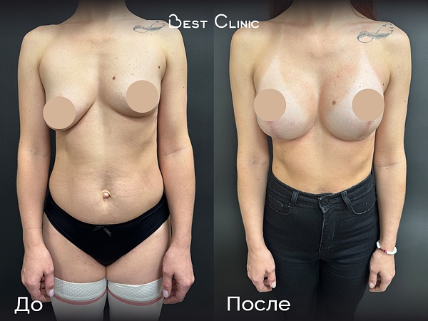 Подтяжка с увеличением. Коррекция асимметрии