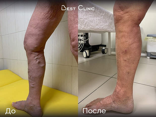 ЭВЛК с минифлебэктомией притоков голени