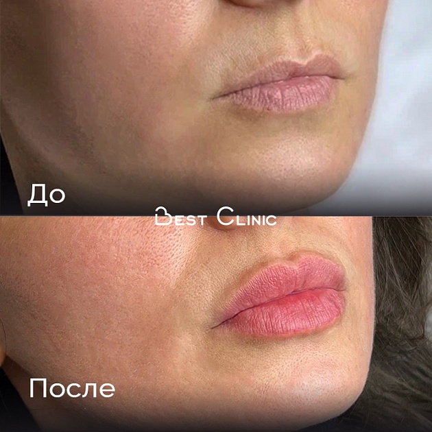 Увеличение губ