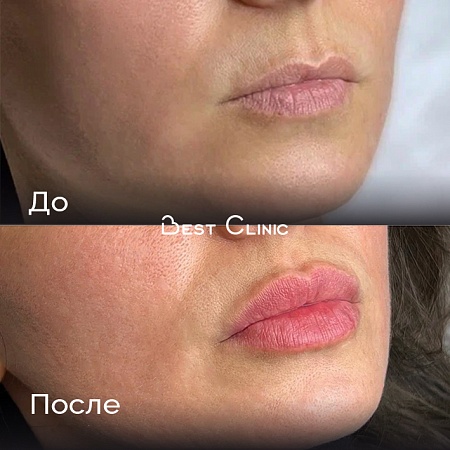 Увеличение губ