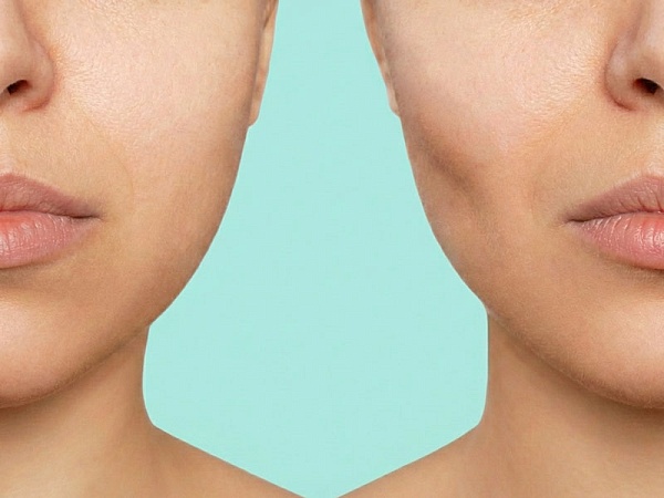 Удаление комков Биша