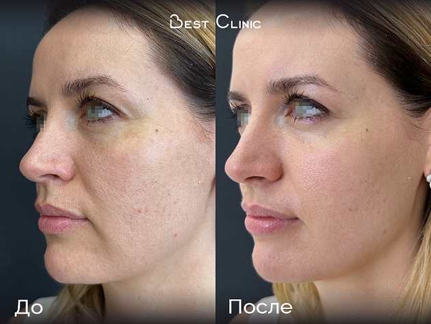 Игольчатый RF-лифтинг