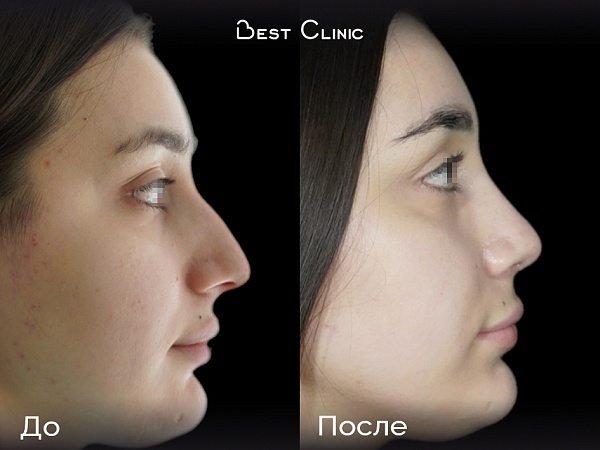 Ринопластика