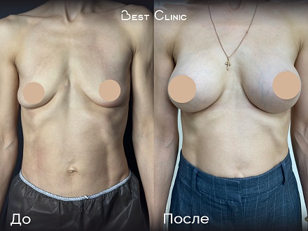 Аугментационная маммопластика анатомическими имплантатами 300 мл