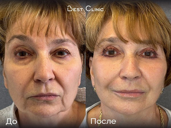 Подтяжка (SMAS лифтинг)+ блефаропластика