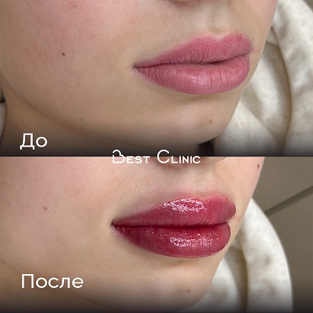 Увеличение губ