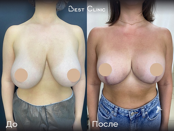 Редукционная мастопексия без имплантов