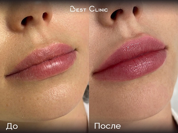 Увеличение губ