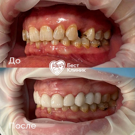 Керамические виниры