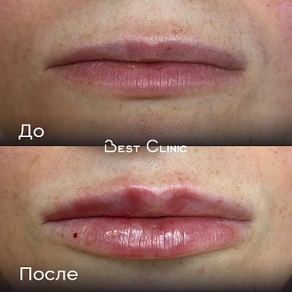 Контурная пластика губ (Belotero Lips Shape)